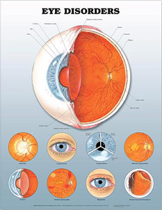 Eye Disorders  3D Lenticular Chart
