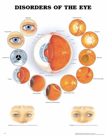 eye disorders chart charts