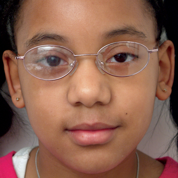 Wearing Eye Patch For Amblyopia